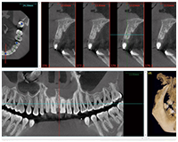 精密な診査・診断を院内で可能に～歯科用CT～