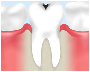 歯が「痛い」「しみる」と感じたら早めの受診を