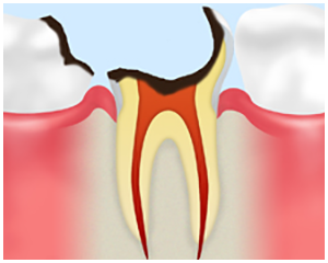 虫歯を放置する危険性