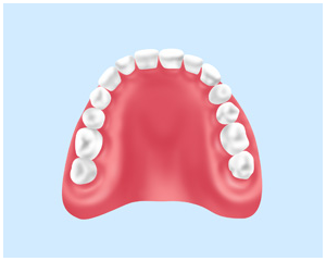 プラスチック床（レジン義歯）……保険適用