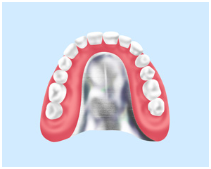 金属床義歯……保険適用外