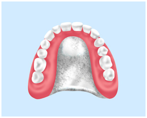 チタン床（金属床義歯の一種）……保険適用外