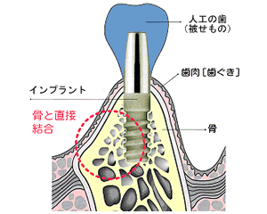 当院のインプラント治療