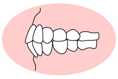 上下顎前突（じょうげがくぜんとつ）