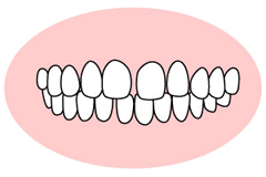 空隙歯列（くうげきしれつ）正中離開（せいちゅうりかい）