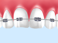 一般矯正（ブラケット方式）